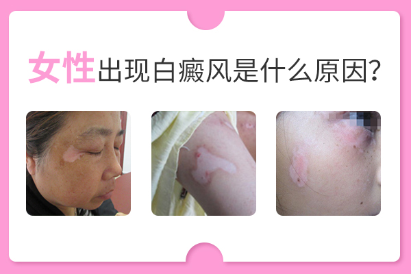 女性身上會產(chǎn)生白癜風(fēng)與什么因素有關(guān)?