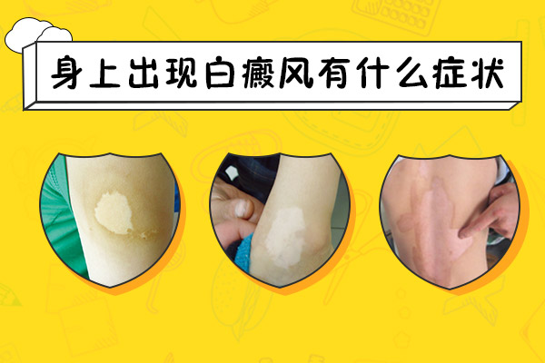 身上出現(xiàn)白癜風(fēng)有什么癥狀呢？